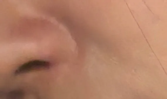 광대수술 비고정으로 했었는데2