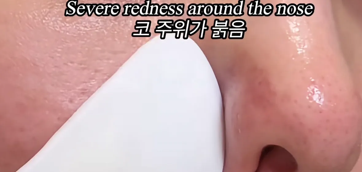 피부장벽 무너진 신호