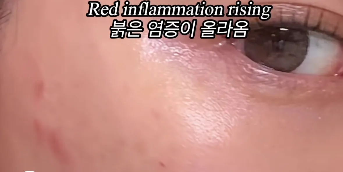 피부장벽 무너진 신호2