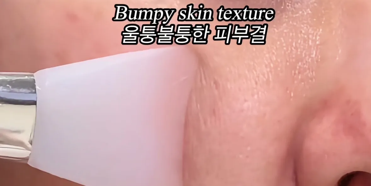 피부장벽 무너진 신호3