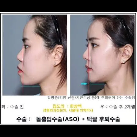 저 옆모습 이사람처럼 생겻는데 양악해야되겟죠