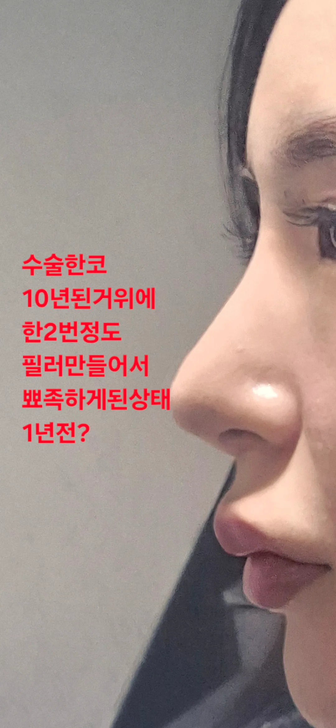 코필러 다시 맞을때 된거같죠? 답바랍니다2