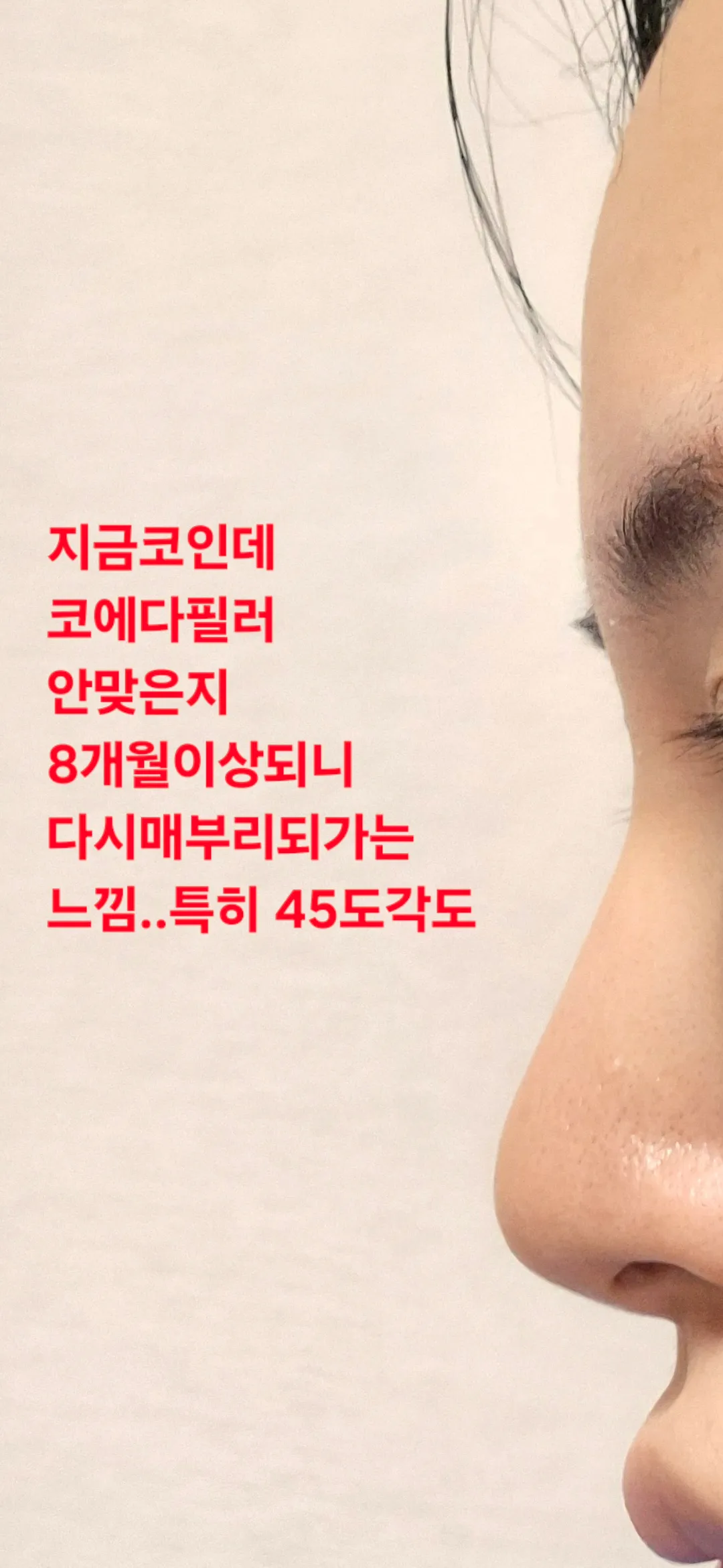 코필러 다시 맞을때 된거같죠? 답바랍니다3