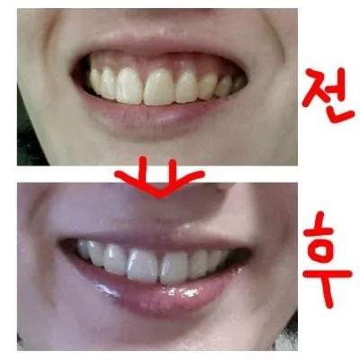 잇몸성형 해 본 언니들 있어용?ㅋㅋ