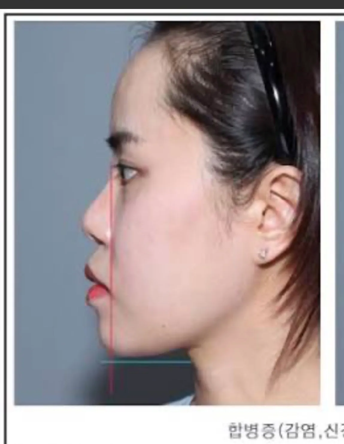 저같은 얼굴중에 양악 효과본 언니 잇나여??