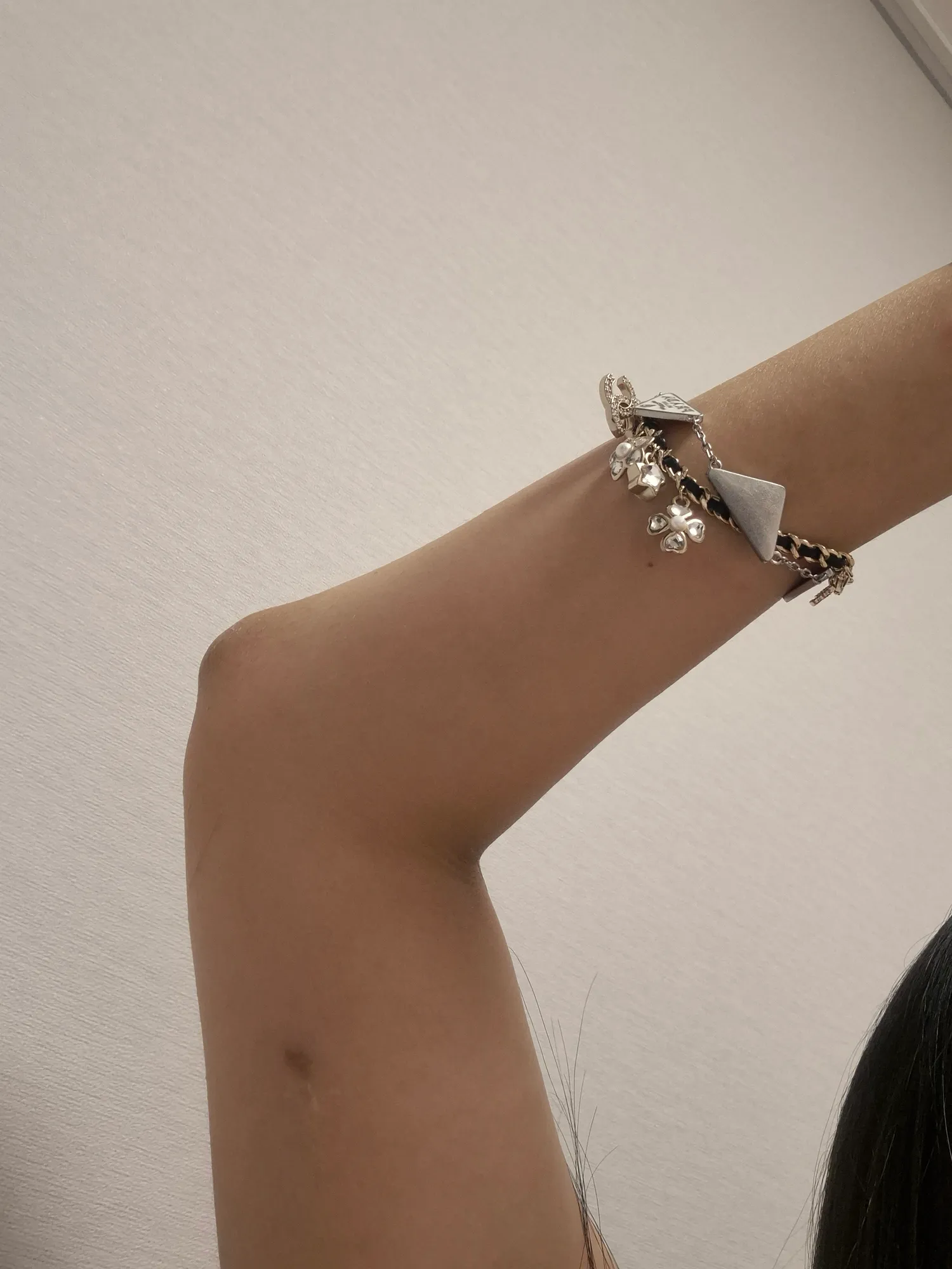 임플라논 잘못넣은거맞지? 왜 멍이생겨?