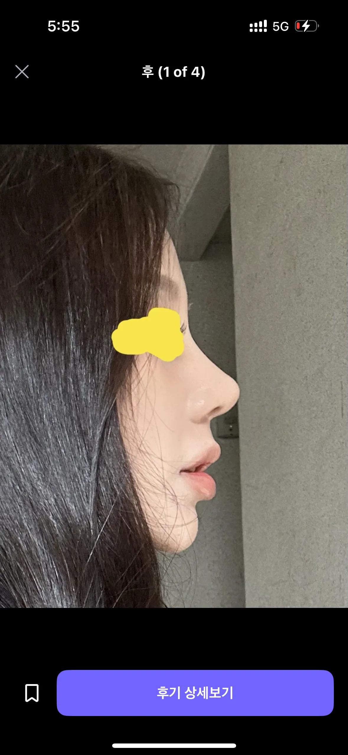코 어디가 나아요?2