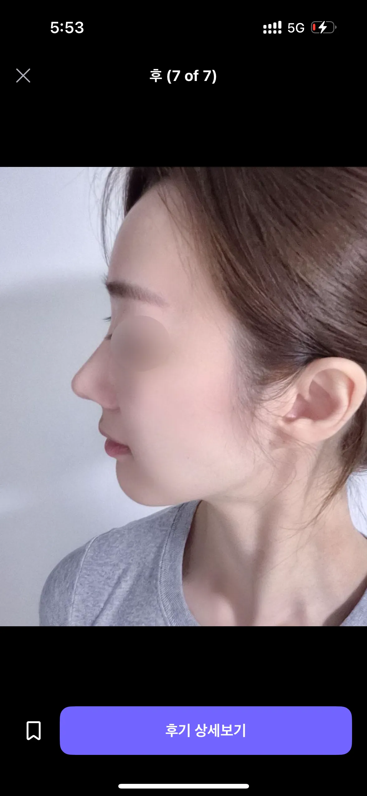 코 어디가 나아요?3