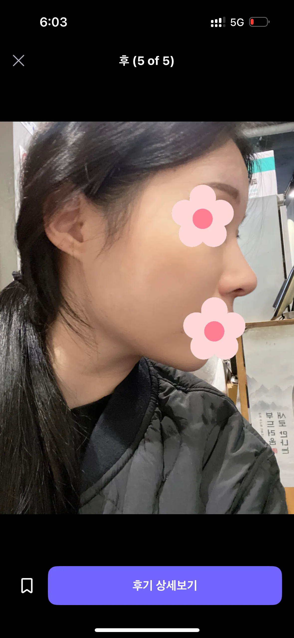 코 어디가 나아요?4