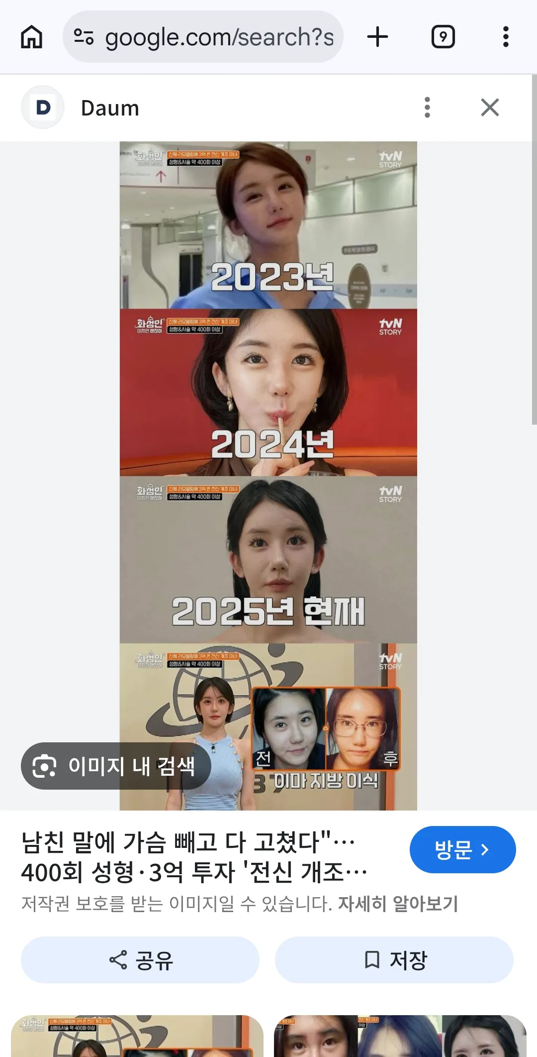 양악하고 쳐지면 댓글