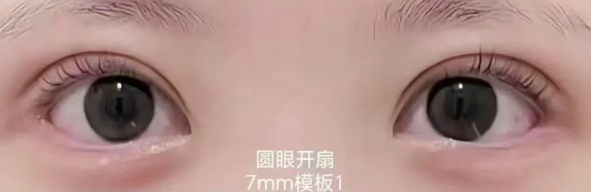 눈 라인