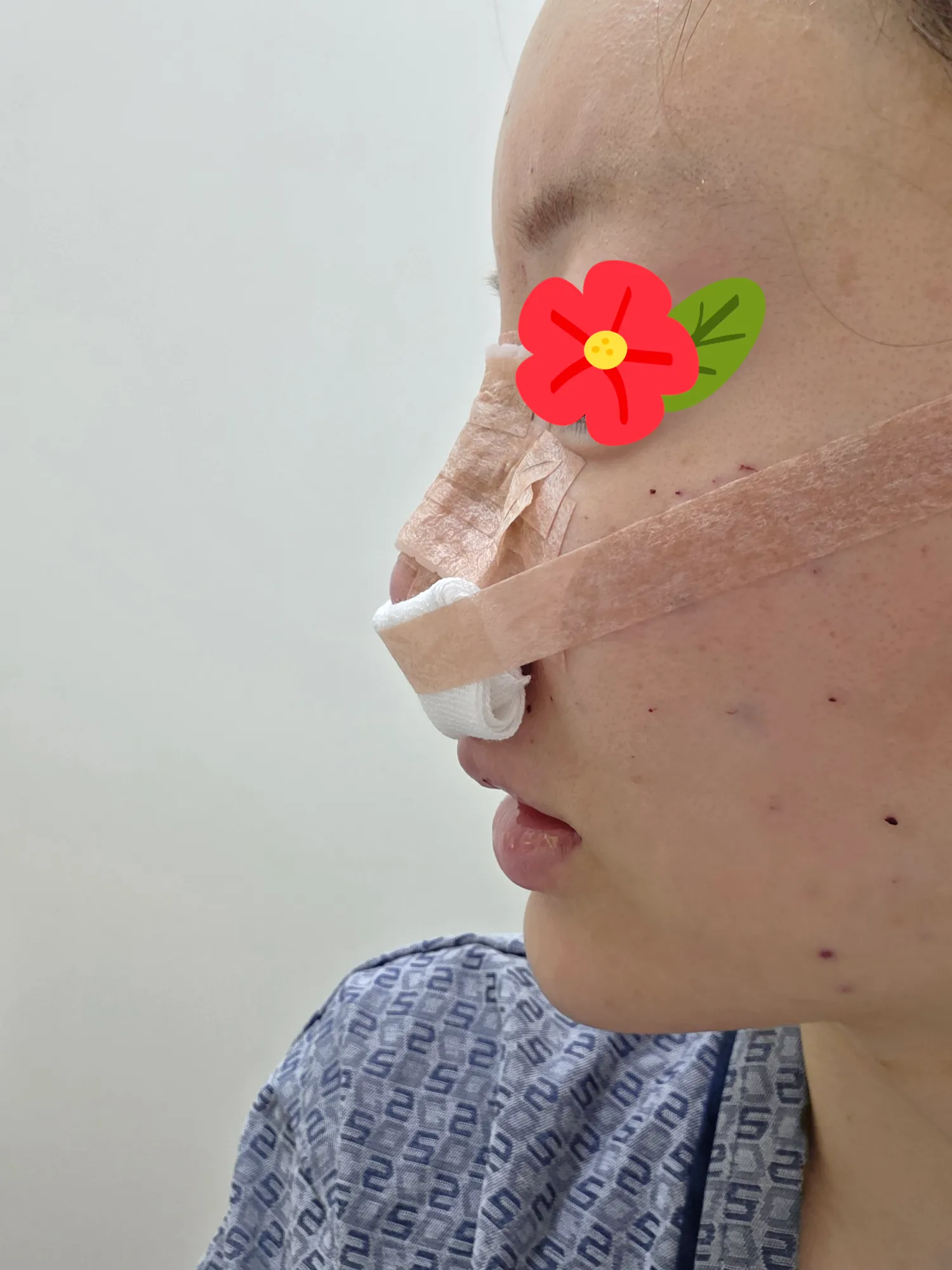 저금방 코수술햇는데