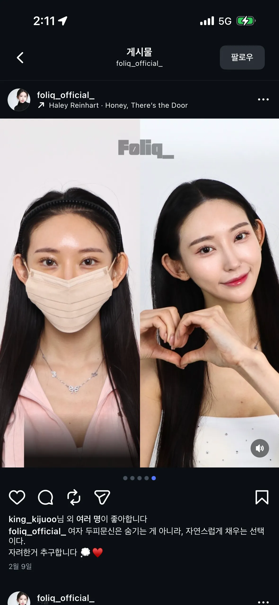 두피문신2