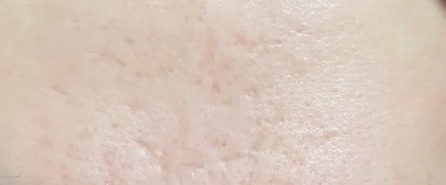 일케 피부 패인건 왜그런거예용2