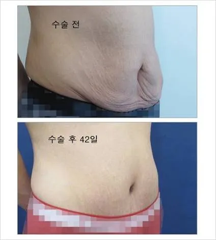 임신한사람중에 배 이렇게되는건왜그래요?