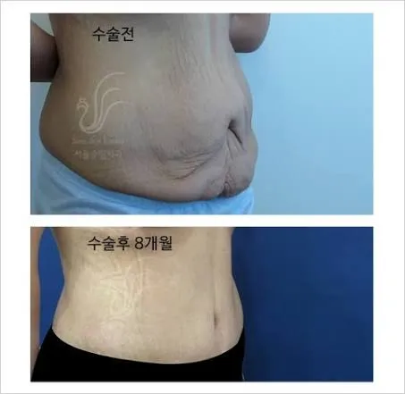 임신한사람중에 배 이렇게되는건왜그래요?2