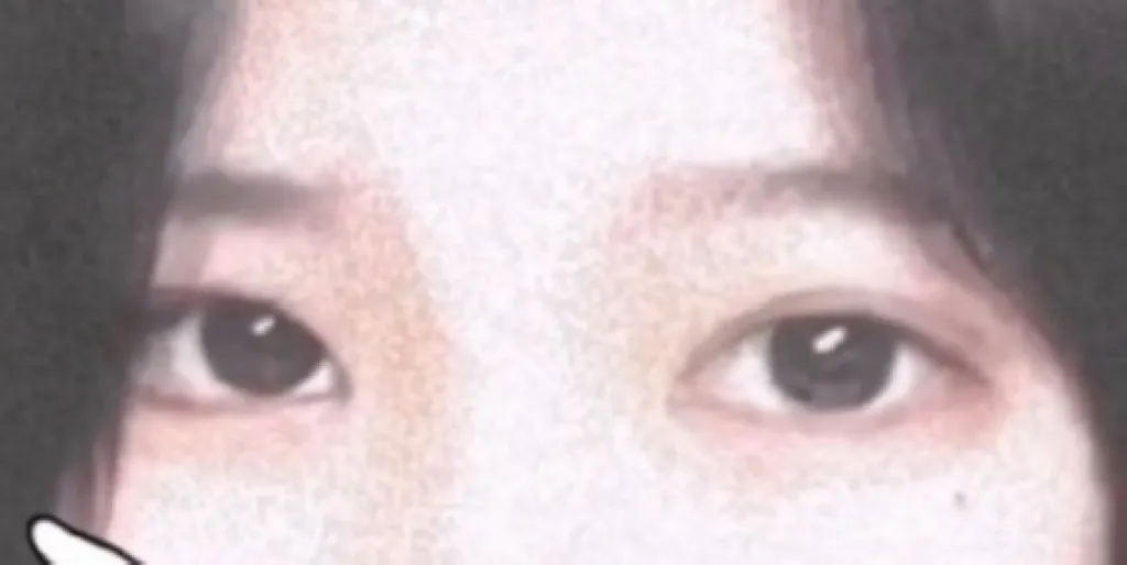 쌍수 할까말까