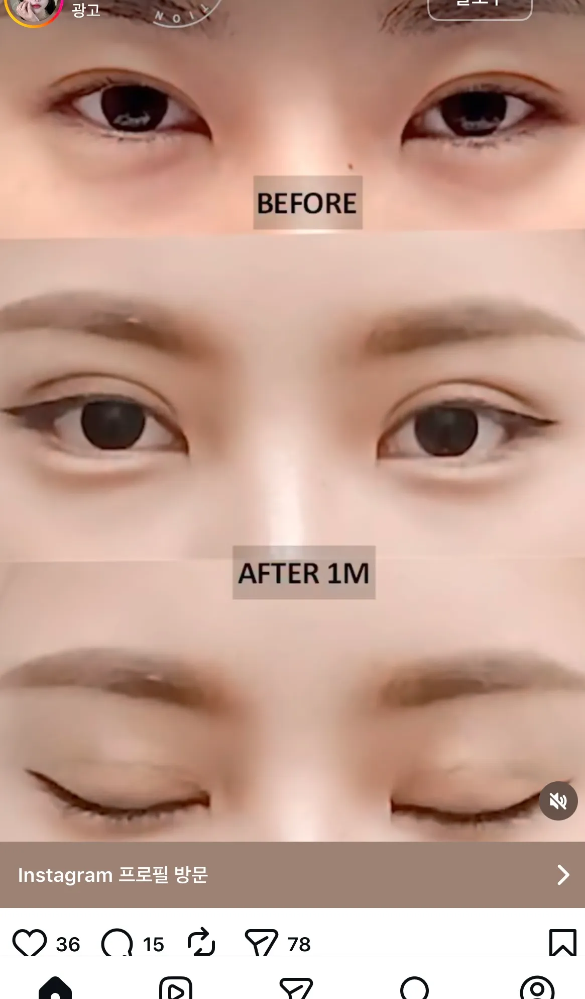 병원 광고 왜 비포가 더 나은 거 같지...