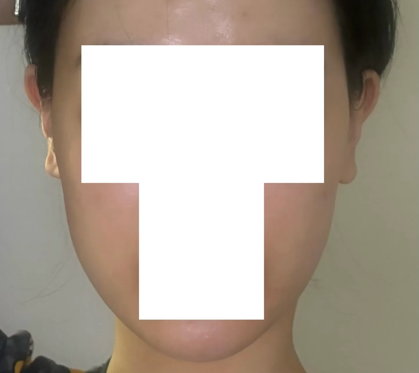 얼테기와서 시술 받으러 가기 전에..