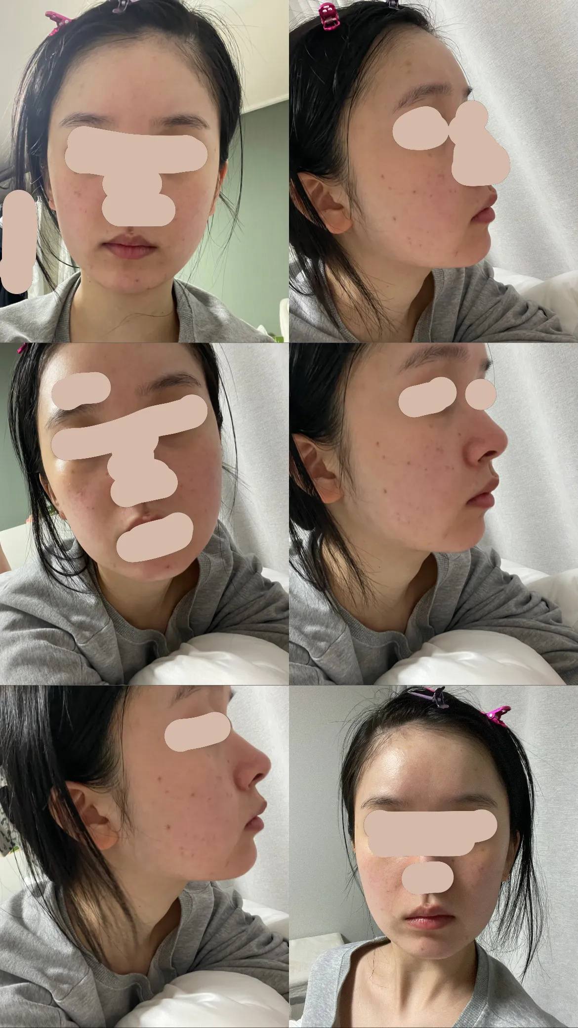 윤곽 없이 양악만 해도 괜찮을까요? 댓글