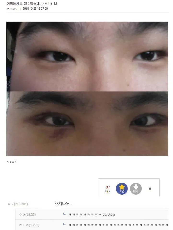 남자 쌍수 레전드