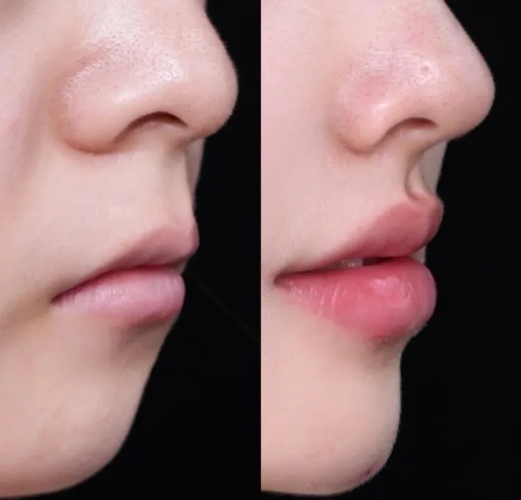 저도 요새 인중 정병 오져요