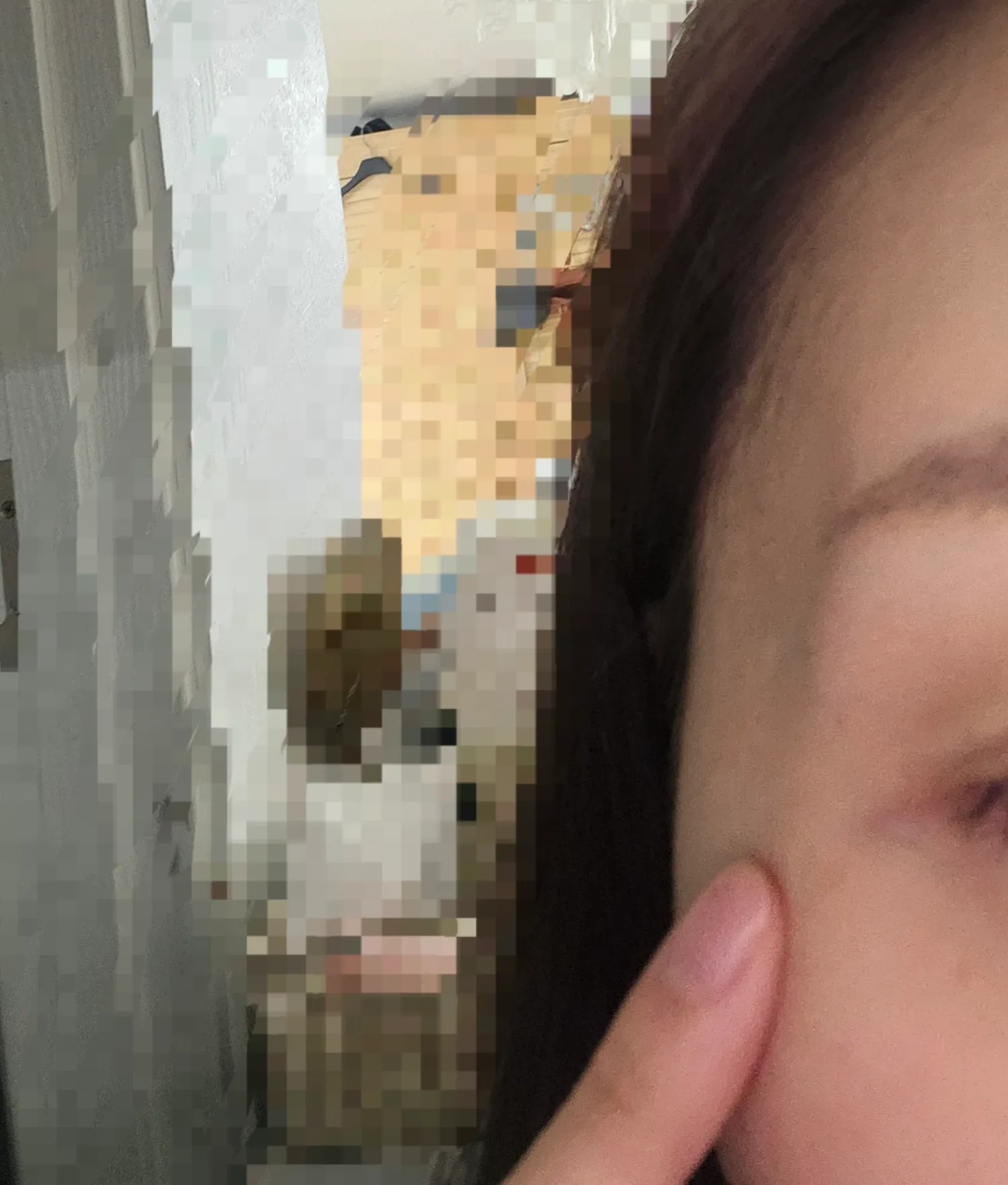 하 측두근보톡스 잘못 맞으면 ㅈ되네여 진자2