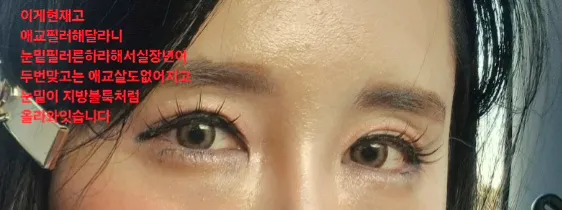 좀잇다글삭 제가 눈밑필러맞고 확늙어졌어요2