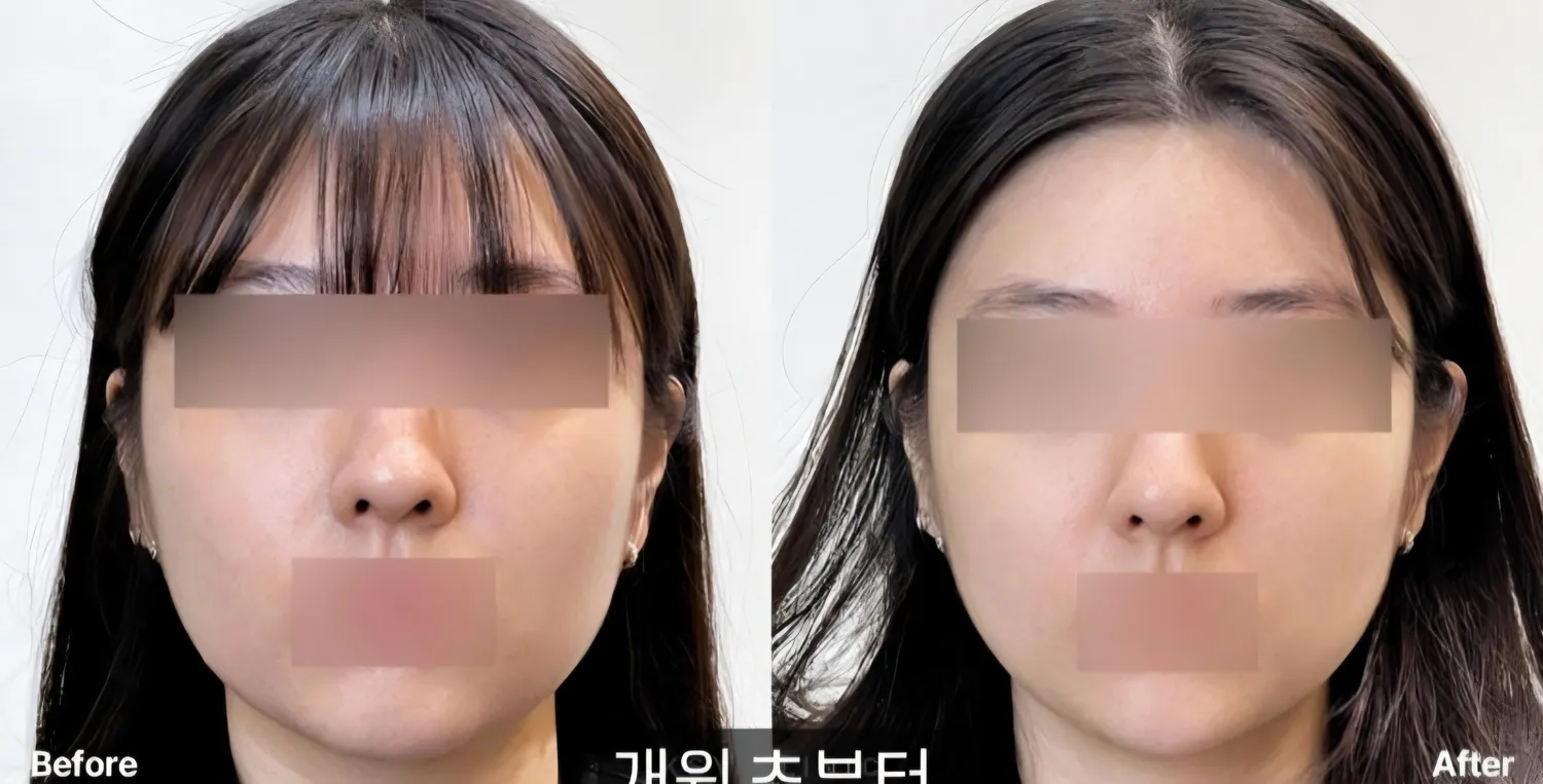 시술 알아보고 있는데 비포 엪터 차이있는것같나요?