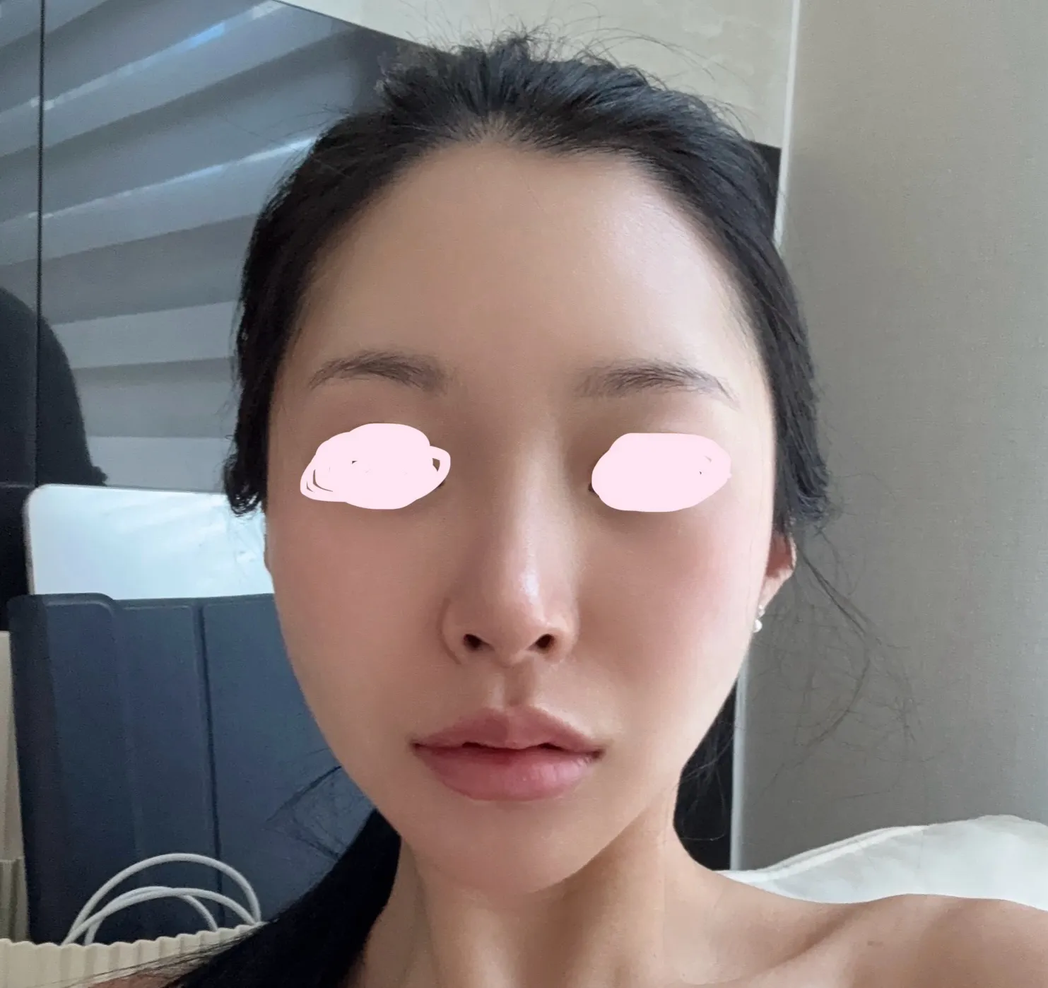 언니들 관자놀이 필러 맞을까여
