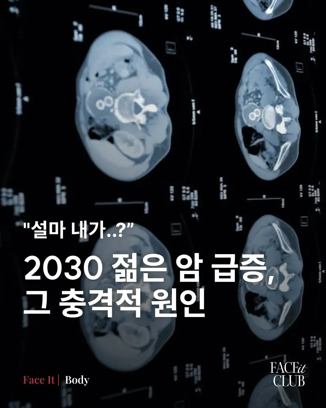 젊은 암환자 숫자가 급증한 이유 2가지