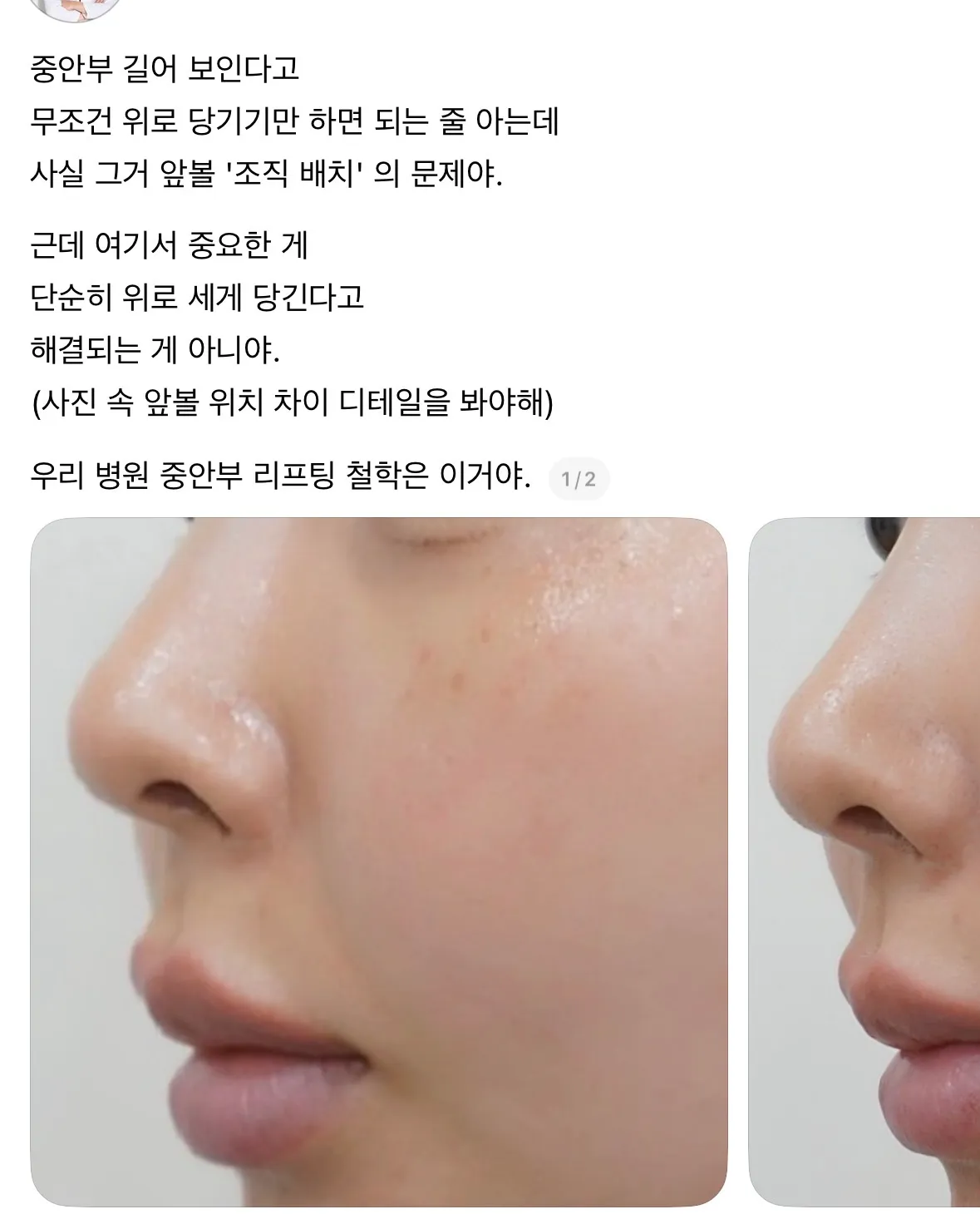 중안부 리프팅 하고싶삼...