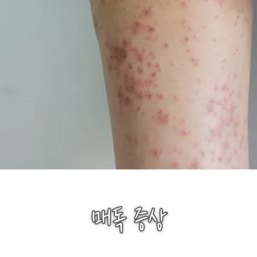 매독달고 피부염이라는 한남 많음
