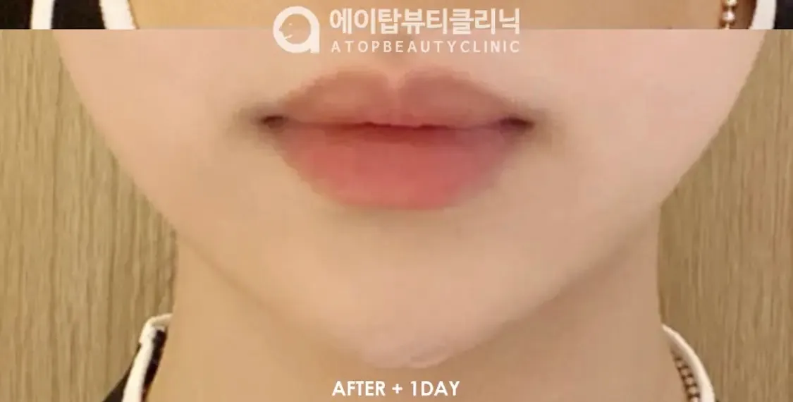 턱주가리필러 또 망했네...2