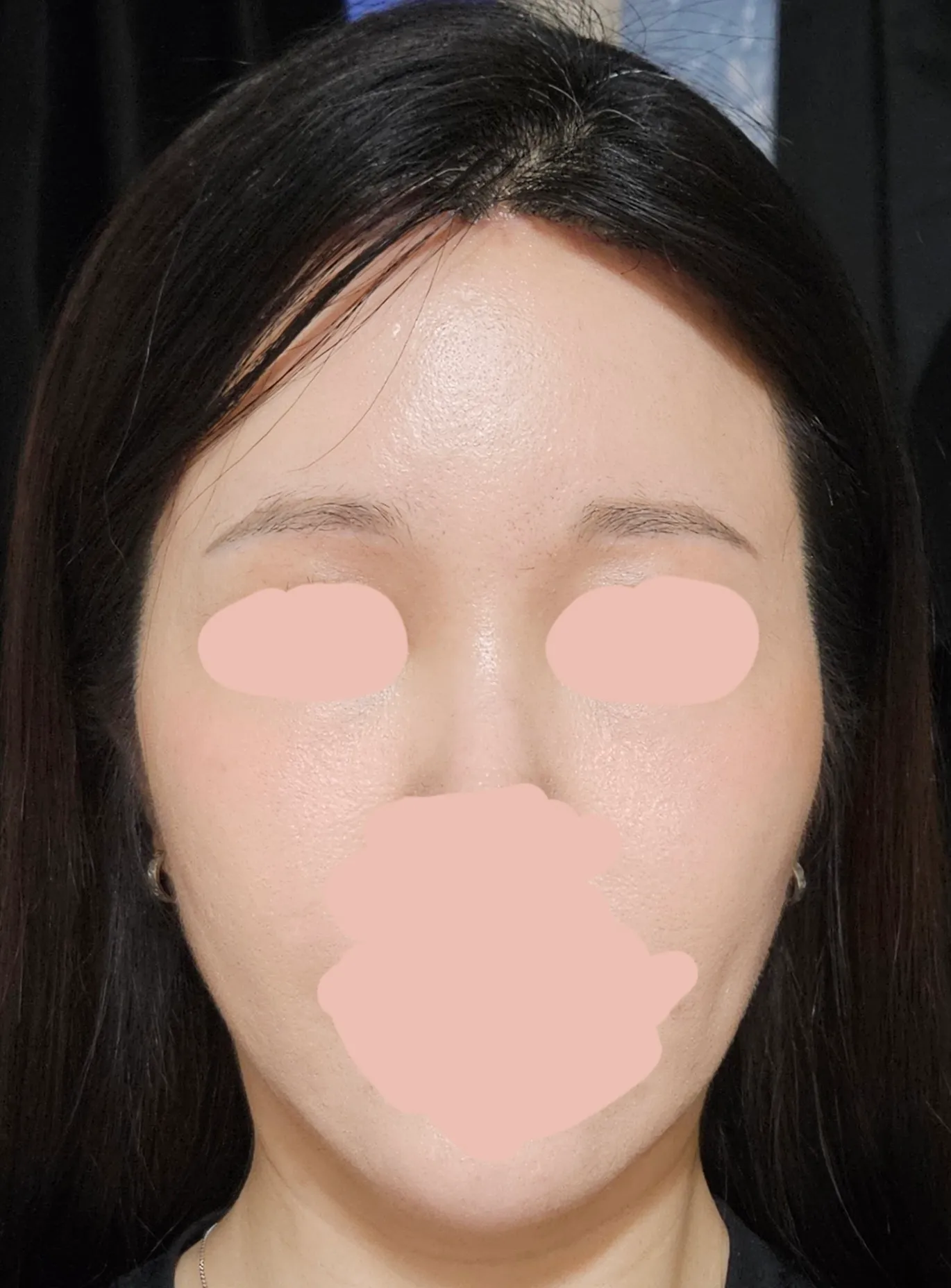 광대 깎을까요?