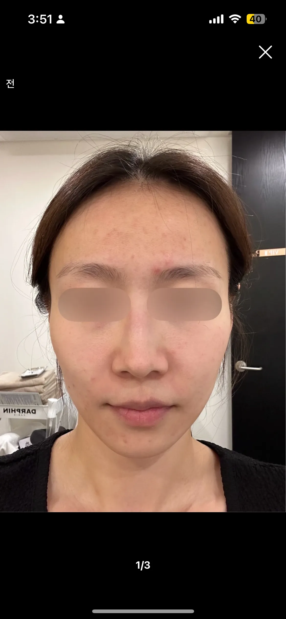 볼뉴머+슈링크 조합 알아보는중인데