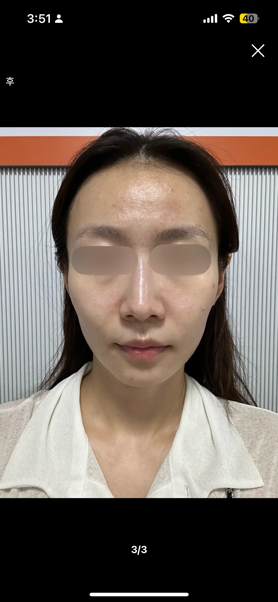 볼뉴머+슈링크 조합 알아보는중인데2