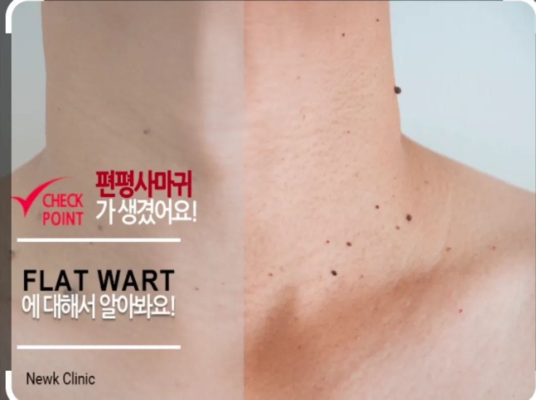편병사마귀 접촉으로도 옮는대요 ㅅㅂ