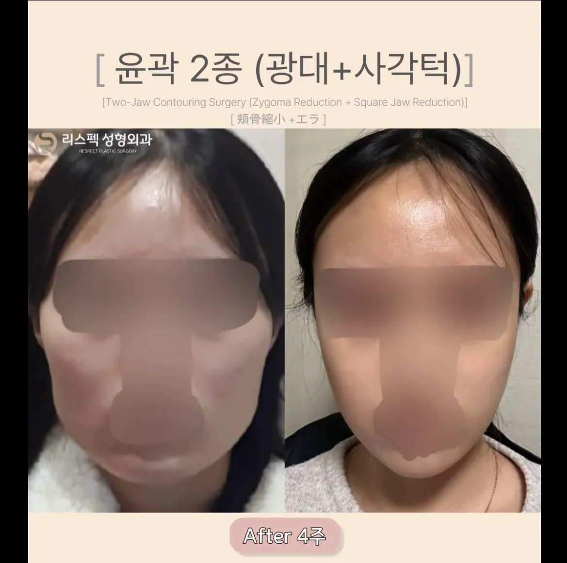 엥 윤곽 4주만에 붓기가잏케 없음?