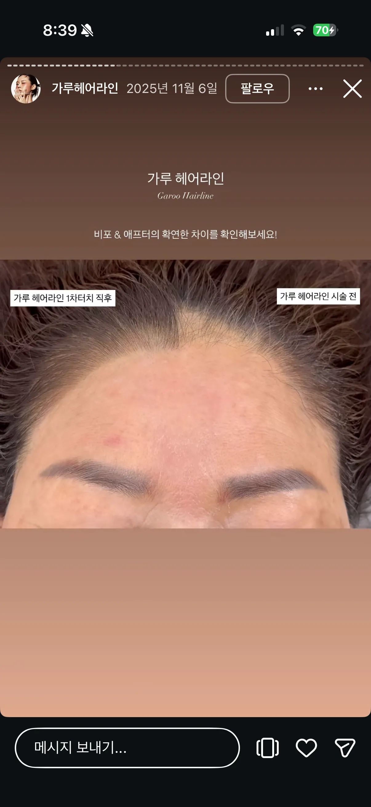 헤어라인 반영구 어디가 잘하는거같아요..?3