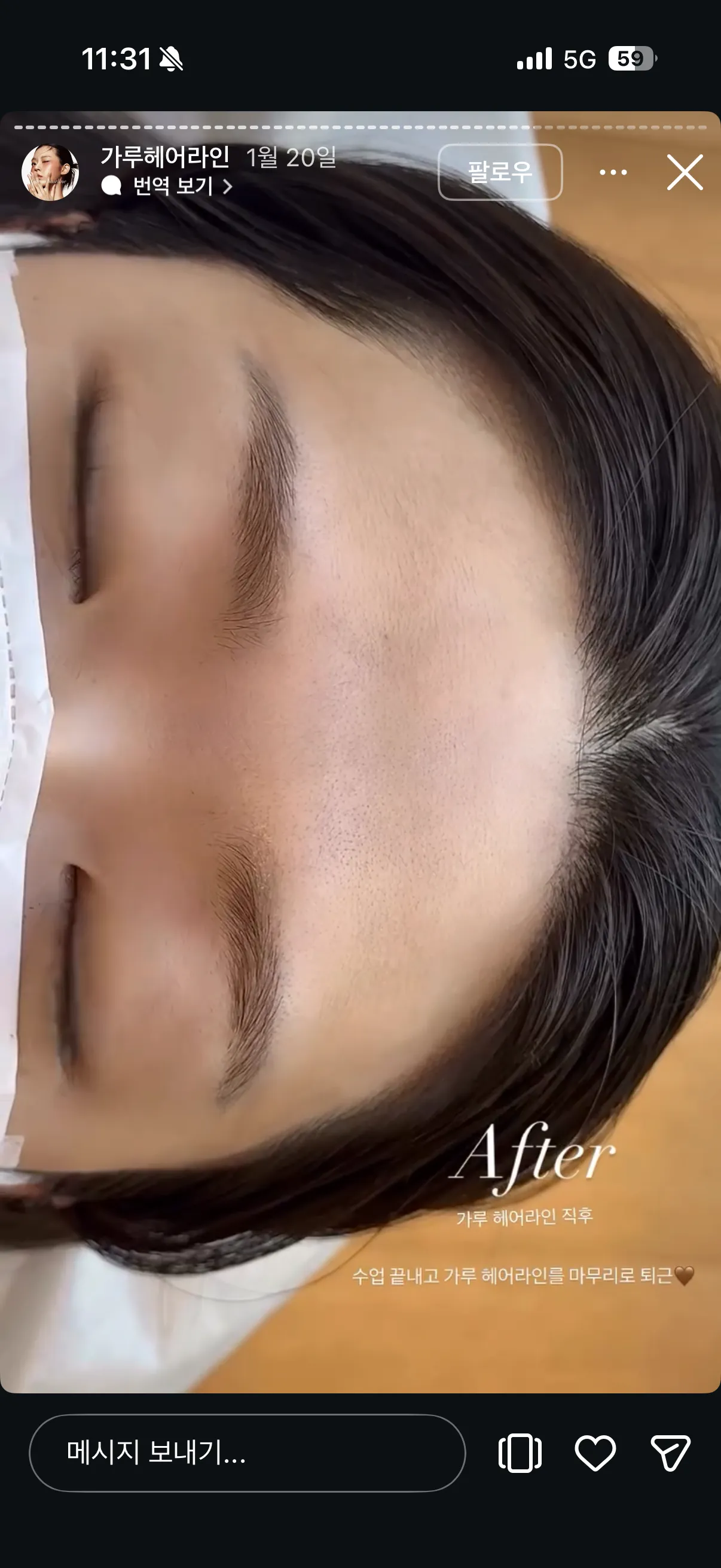 헤어라인 반영구 어디가 잘하는거같아요..?4