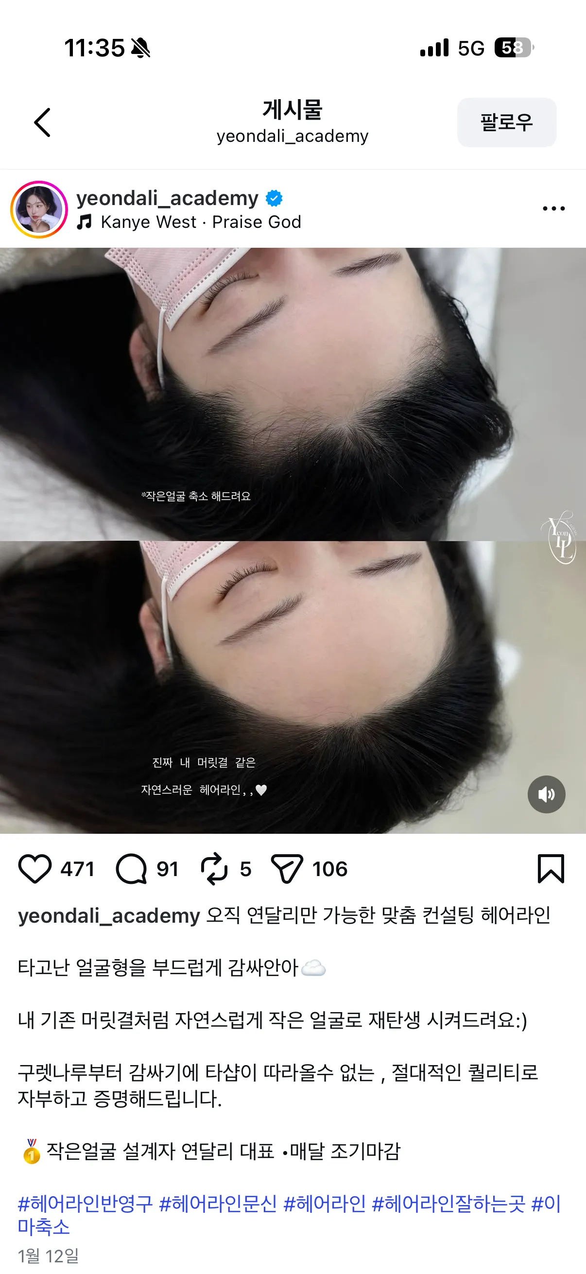헤어라인 반영구 어디가 잘하는거같아요..?6