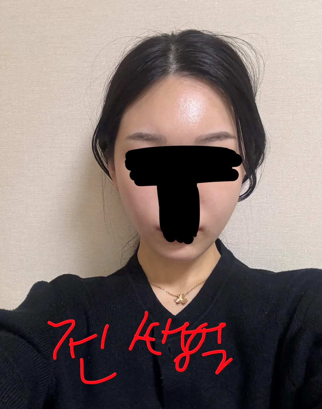 윤곽재수술 어때보여요??