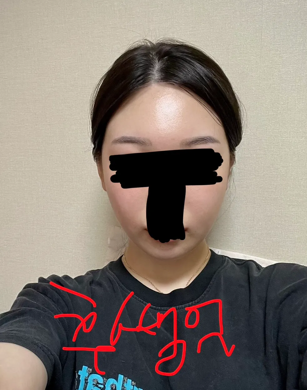 윤곽재수술 어때보여요??2