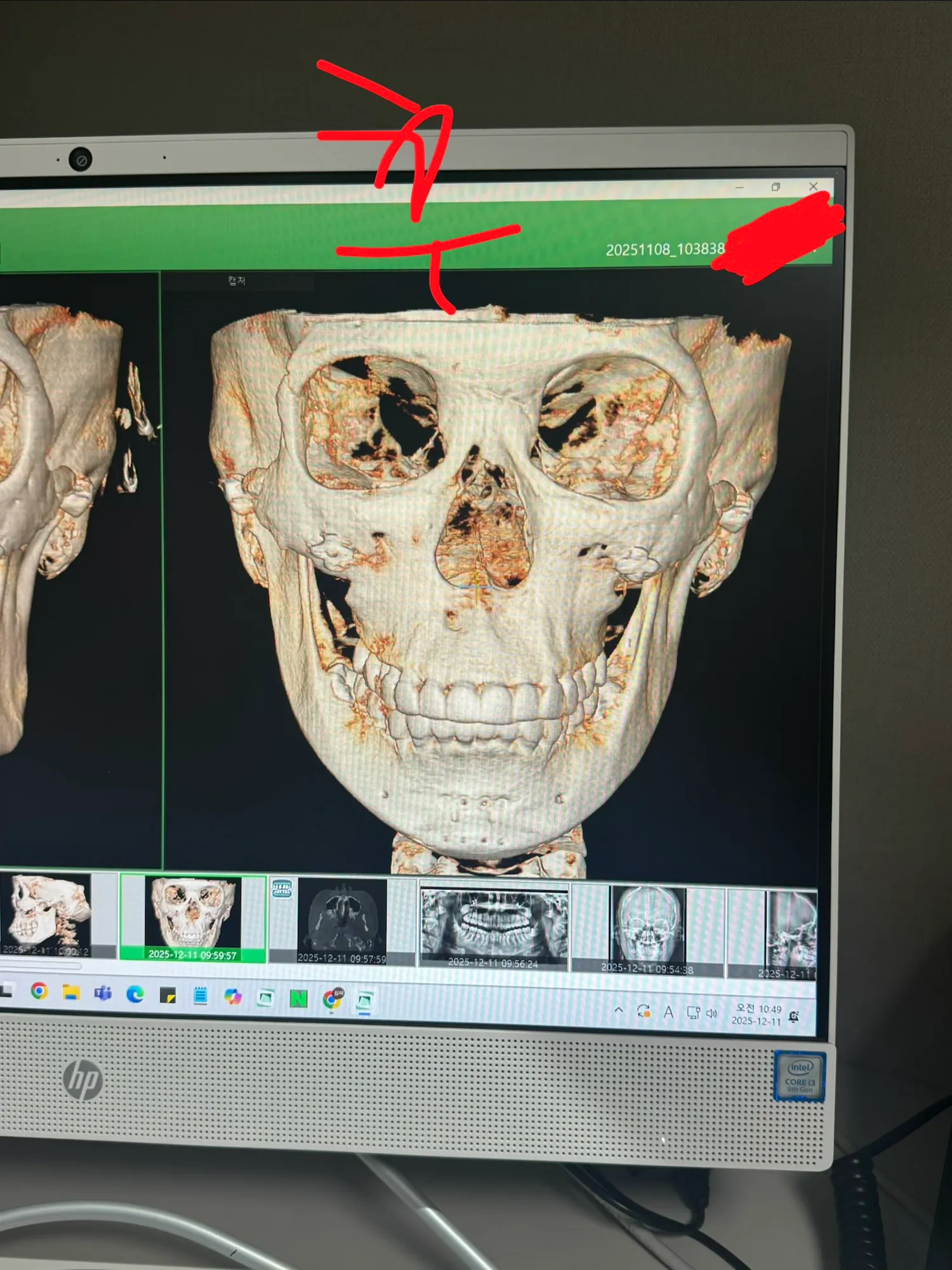 윤곽재수술 어때보여요?? 댓글 2