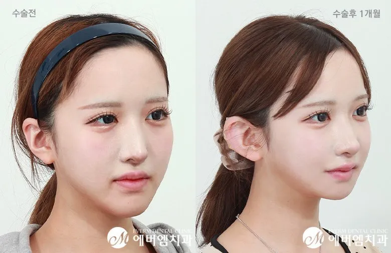 양악 이거