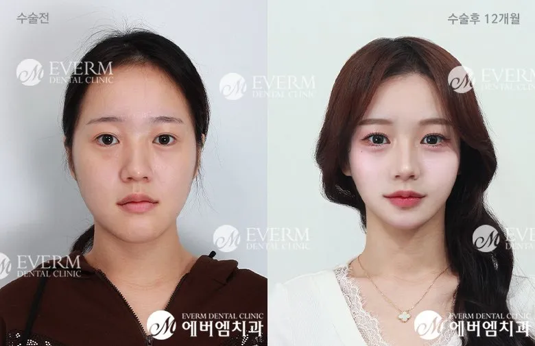 양악 이거3