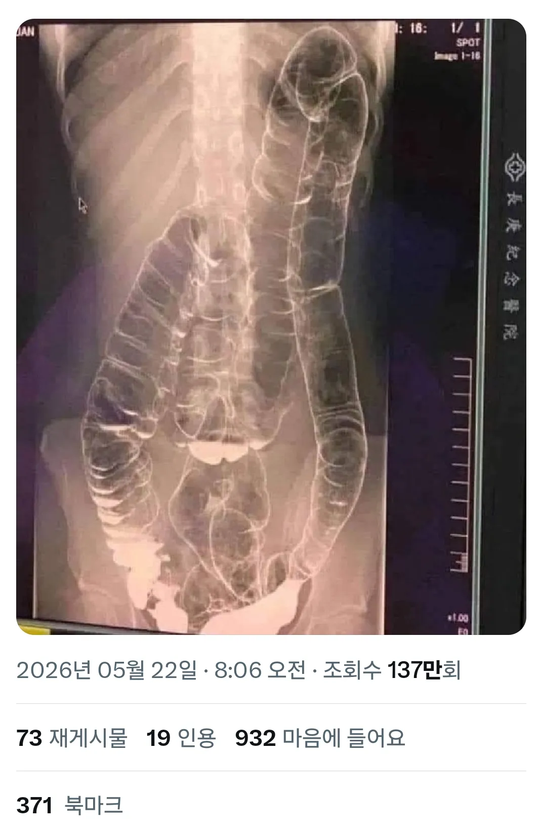 변비가 무서운 이유3