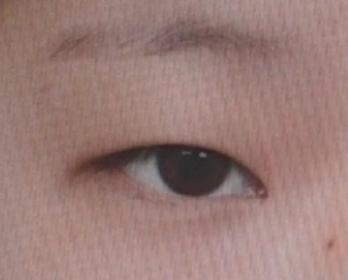 쌍수 전후