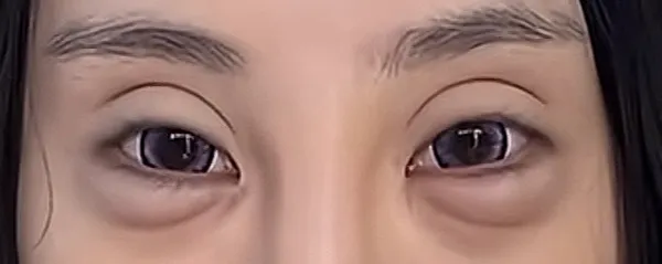 ? 위아래로 애굣살이 네개네